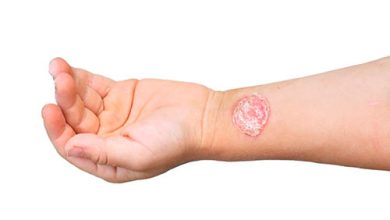 Photo of Стрептодермия у детей: симптомы