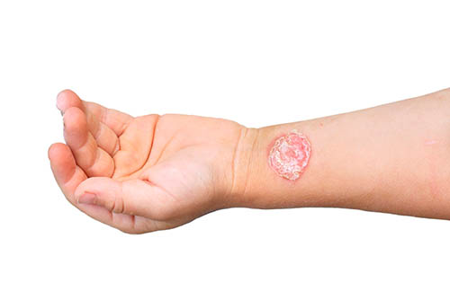 Photo of Стрептодермия у детей: симптомы