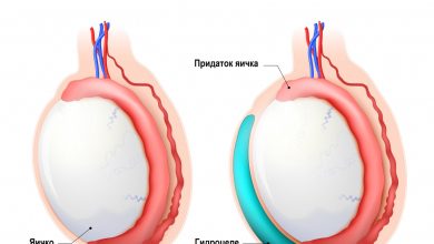 Photo of Опасность водянки у детей