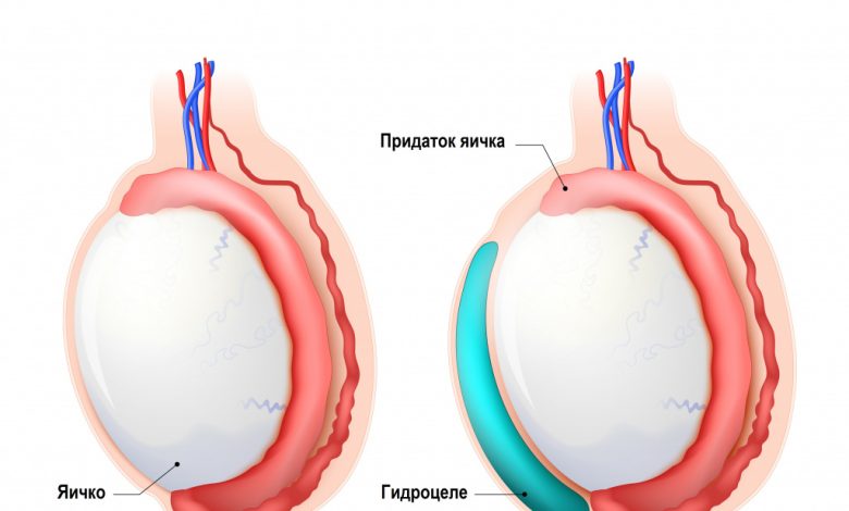 Photo of Опасность водянки у детей