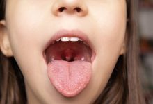 Photo of Чем опасен ангина у детей
