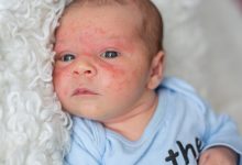 Photo of Детский дерматит: как избежать