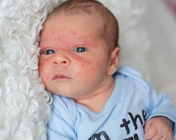 Photo of Детский дерматит: как избежать